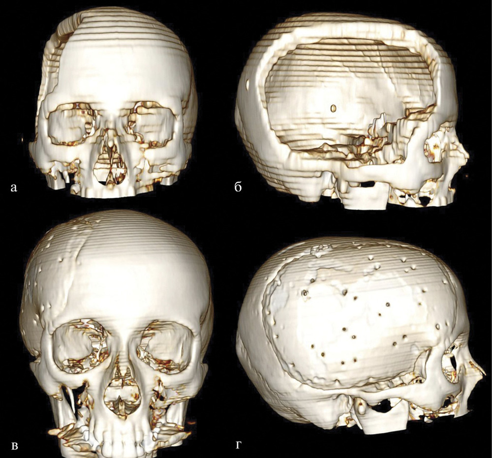 Череп после. Краниопластика черепа операция. Краниопластика черепа имплант. Краниопластика свода черепа. Пластика дефектов черепа (краниопластика).